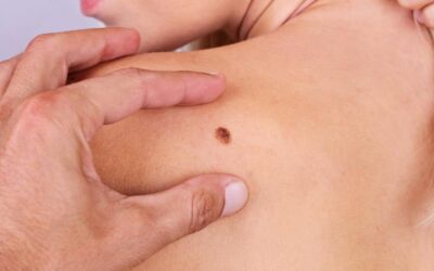 Not all Melanomas are brown or black, what other type of melanoma should you be on alert for?